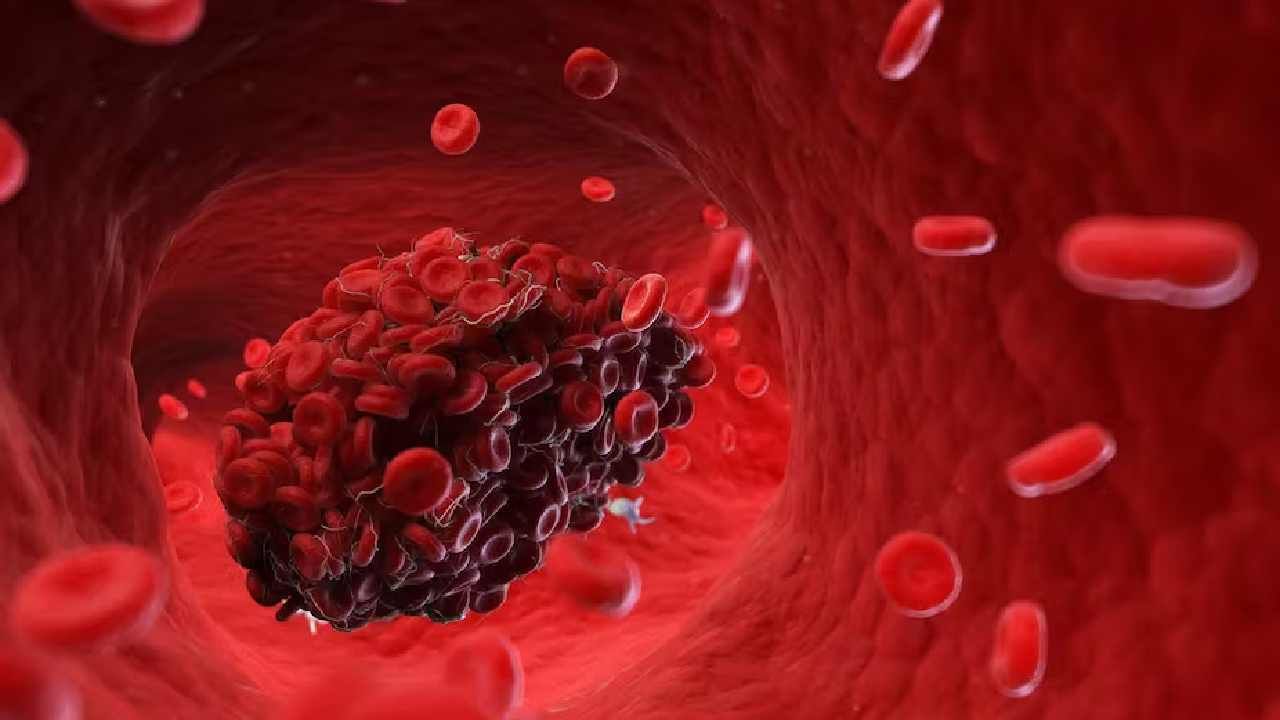 Blood Clot: ರಕ್ತ ಹೆಪ್ಪುಗಟ್ಟುವಿಕೆಯಿಂದ ಪರಿಹಾರ ಪಡೆಯಲು ಈ 5 ಮನೆಮದ್ದುಗಳನ್ನು ಅನುಸರಿಸಿ Blood Clot: ರಕ್ತ ಹೆಪ್ಪುಗಟ್ಟುವಿಕೆಯಿಂದ ಪರಿಹಾರ ಪಡೆಯಲು ಈ 5 ಮನೆಮದ್ದುಗಳನ್ನು ಅನುಸರಿಸಿ