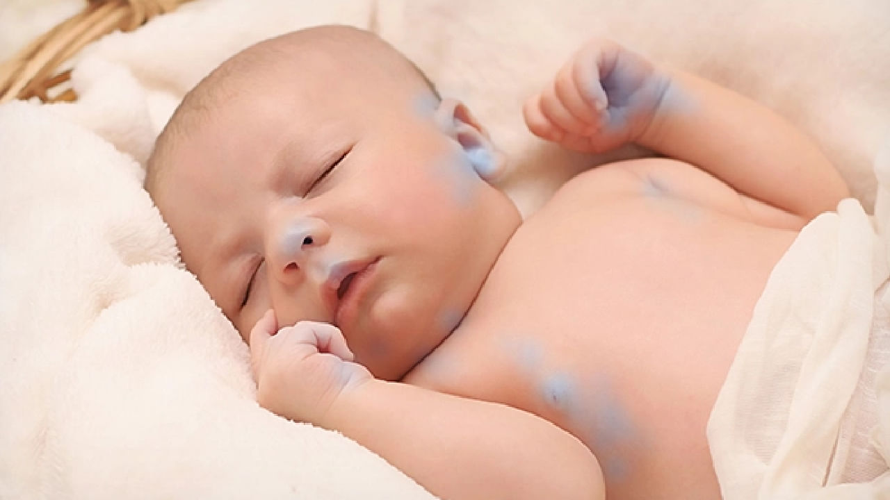 Blue Baby Syndrome: ಬ್ಲೂ ಬೇಬಿ ಸಿಂಡ್ರೋಮ್ ಎಂದರೇನು? ಇದಕ್ಕೆ ಕಾರಣವೇನು?