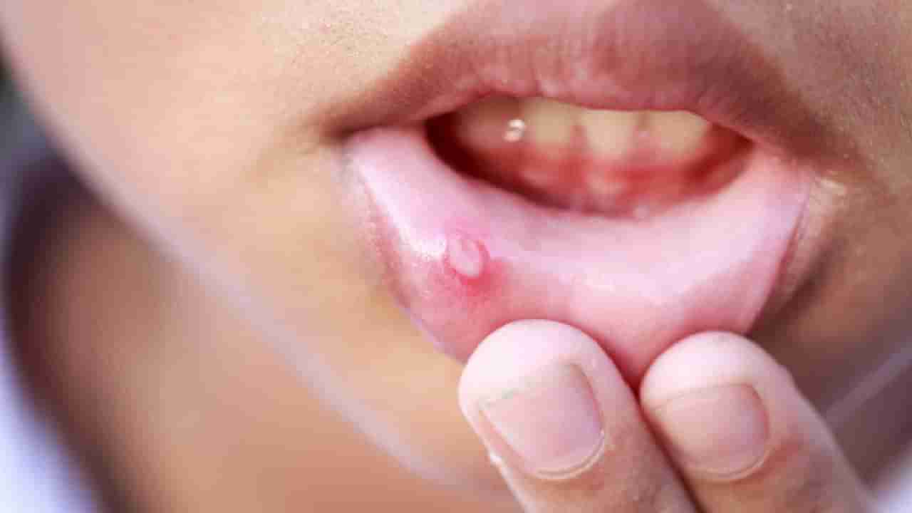 Mouth Ulcers: ನೀವು ಬಾಯಿ ಹುಣ್ಣು ಹೊಂದಿದ್ದರೆ ಈ 6 ಆಹಾರಗಳಿಂದ ದೂರವಿರಿ