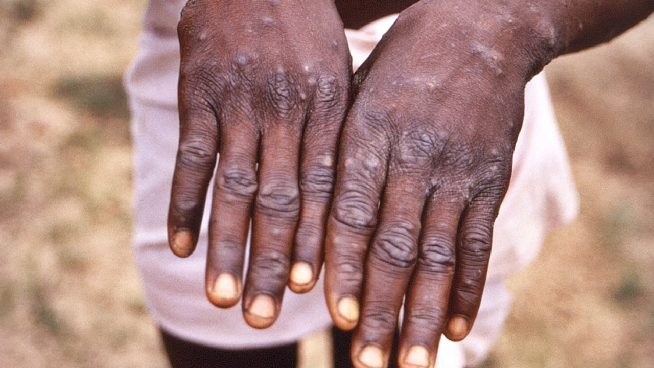 Monkeypox virus - Kyasanur Forest Disease (ಮಂಗನ ಕಾಯಿಲೆ)