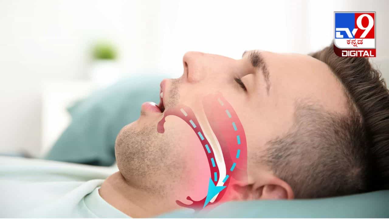 Sleep Apnea: ಹಗಲಿನಲ್ಲಿ ಅತಿಯಾದ ನಿದ್ರೆ ಮಾಡುವವರಿಗೆ ಸೂಕ್ತ ಚಿಕಿತ್ಸೆ: ಇಲ್ಲಿದೆ ಸಂಶೋಧನ ಮಾಹಿತಿ Sleep Apnea: ಹಗಲಿನಲ್ಲಿ ಅತಿಯಾದ ನಿದ್ರೆ ಮಾಡುವವರಿಗೆ ಸೂಕ್ತ ಚಿಕಿತ್ಸೆ: ಇಲ್ಲಿದೆ ಸಂಶೋಧನ ಮಾಹಿತಿ