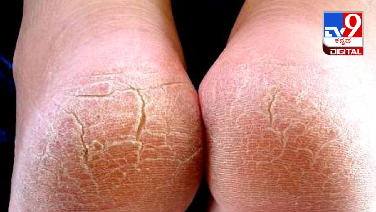 Crack Heels: ಒಡೆದ ಹಿಮ್ಮಡಿ ಸರಿಪಡಿಸಲು ಏನು ಮಾಡಬೇಕು? ಇಲ್ಲಿದೆ ಮನೆಮದ್ದು Crack Heels: ಒಡೆದ ಹಿಮ್ಮಡಿ ಸರಿಪಡಿಸಲು ಏನು ಮಾಡಬೇಕು? ಇಲ್ಲಿದೆ ಮನೆಮದ್ದು