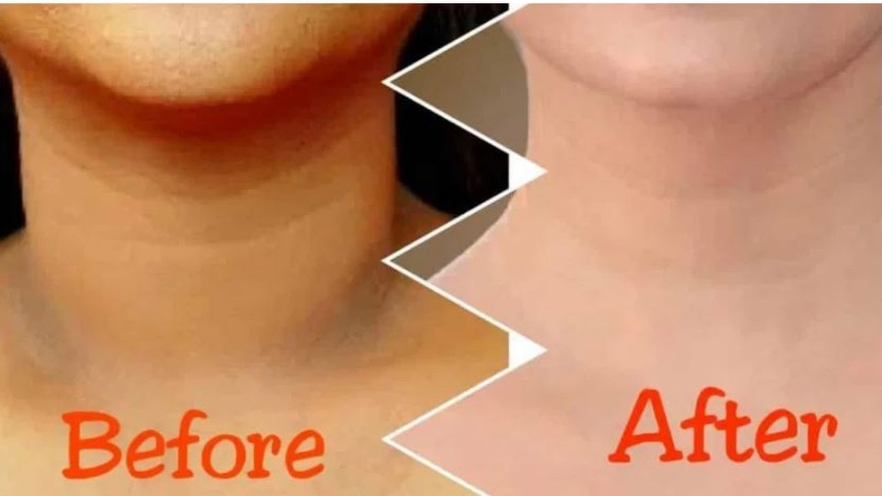 Dark Neck: ಕತ್ತು ದೇಹದ ಸುಂದರ ಭಾಗ, ಅದೇ ಕೊಳೆಗಟ್ಟಿದರೆ ಹೇಗೆ? ಆಯ್ತು ಹೋಗಲಾಡಿಸುವುದು ಹೇಗೆ? ಇಲ್ಲಿದೆ ವಿವರ Dark Neck: ಕತ್ತು ದೇಹದ ಸುಂದರ ಭಾಗ, ಅದೇ ಕೊಳೆಗಟ್ಟಿದರೆ ಹೇಗೆ? ಆಯ್ತು ಹೋಗಲಾಡಿಸುವುದು ಹೇಗೆ? ಇಲ್ಲಿದೆ ವಿವರ