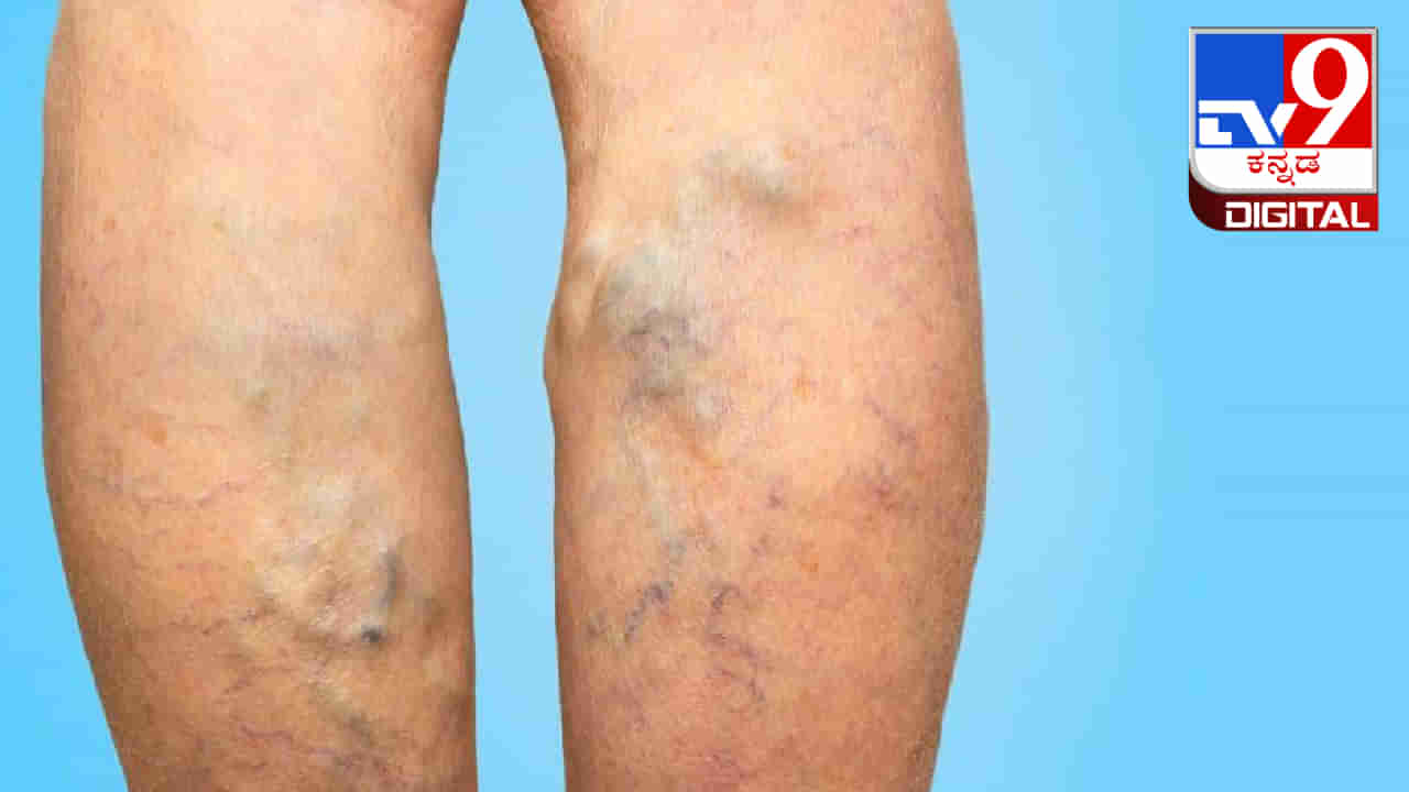 Varicose Veins: ಉಬ್ಬಿರುವ ರಕ್ತನಾಳಗಳನ್ನು ನಿವಾರಿಸುವ ಚಿಕಿತ್ಸೆ ಕುರಿತು ಇಲ್ಲಿದೆ ಮಾಹಿತಿ