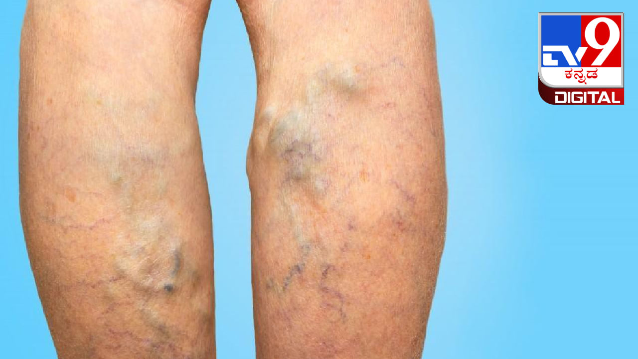 Varicose Veins: ಉಬ್ಬಿರುವ ರಕ್ತನಾಳಗಳನ್ನು ನಿವಾರಿಸುವ ಚಿಕಿತ್ಸೆ ಕುರಿತು ಇಲ್ಲಿದೆ ಮಾಹಿತಿ