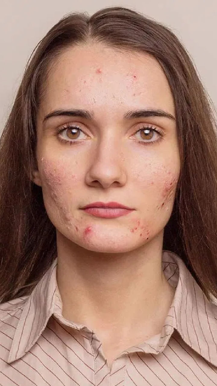 Acne Free (1)