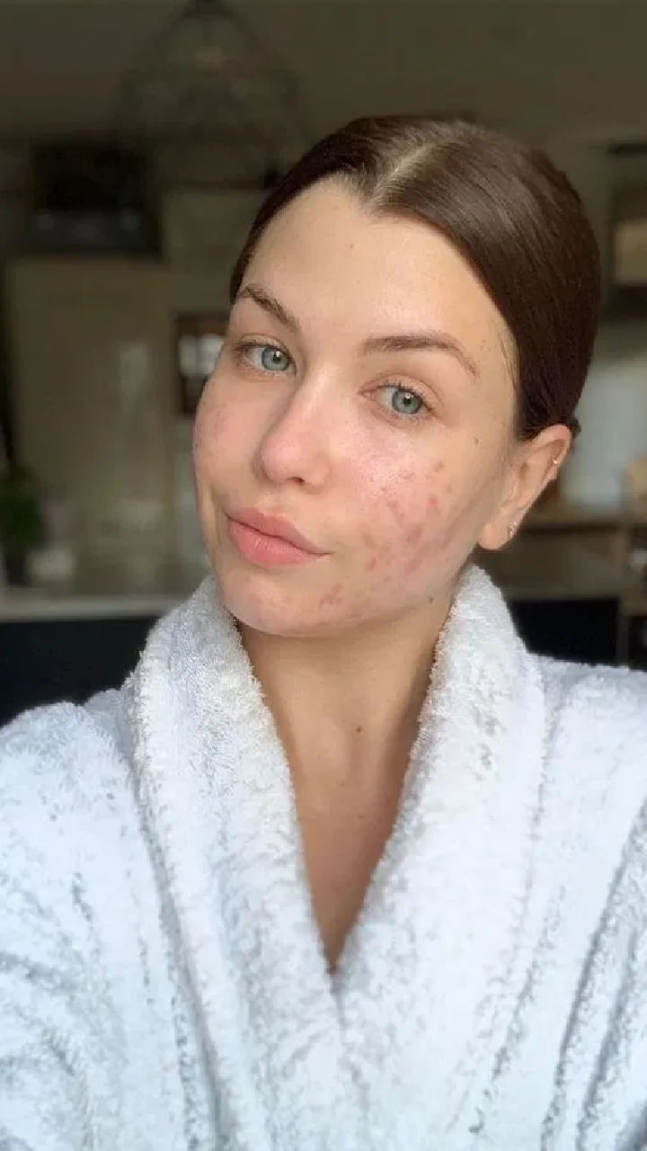 Acne Free (4)