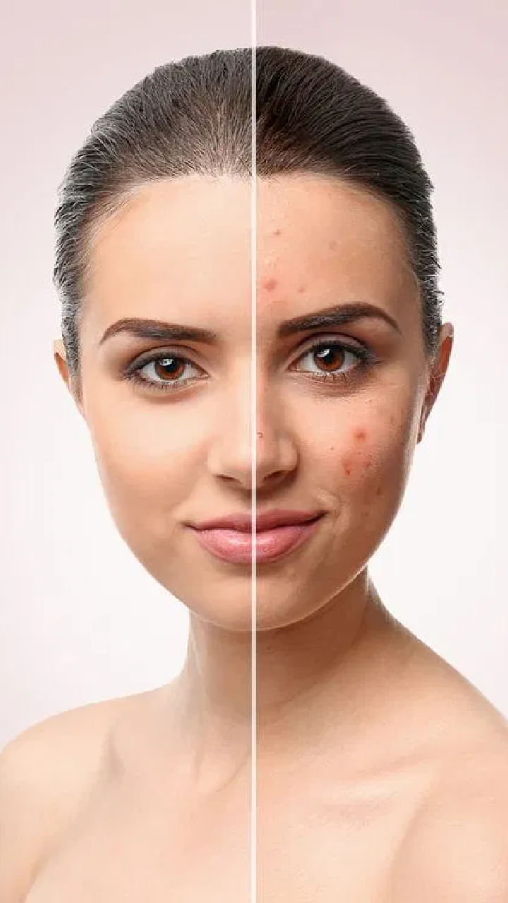 Acne Free