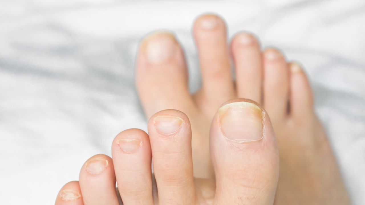 Look at your toenails: ನಿಮ್ಮ ಕಾಲ್ಬೆರಳಿನ ಉಗುರಿನ ಬಣ್ಣದ ಆಧಾರದ ಮೇಲೆ ನಿಮ್ಮ ಆರೋಗ್ಯ ನಿರ್ಧಾರ ಮಾಡಬಹುದು? ಅದು ಹೇಗೆ? Look at your toenails: ನಿಮ್ಮ ಕಾಲ್ಬೆರಳಿನ ಉಗುರಿನ ಬಣ್ಣದ ಆಧಾರದ ಮೇಲೆ ನಿಮ್ಮ ಆರೋಗ್ಯ ನಿರ್ಧಾರ ಮಾಡಬಹುದು? ಅದು ಹೇಗೆ?