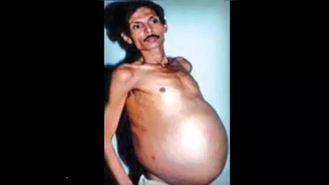 Viral News: ಗಡ್ಡೆಯೆಂದು ವ್ಯಕ್ತಿಗೆ ಶಸ್ತ್ರಚಿಕಿತ್ಸೆ ಮಾಡಿದ್ರೆ ಹೊಟ್ಟೆಯೊಳಗೆ ಅವಳಿ ಮೃತ ಭ್ರೂಣ ಪತ್ತೆ Viral News: ಗಡ್ಡೆಯೆಂದು ವ್ಯಕ್ತಿಗೆ ಶಸ್ತ್ರಚಿಕಿತ್ಸೆ ಮಾಡಿದ್ರೆ ಹೊಟ್ಟೆಯೊಳಗೆ ಅವಳಿ ಮೃತ ಭ್ರೂಣ ಪತ್ತೆ