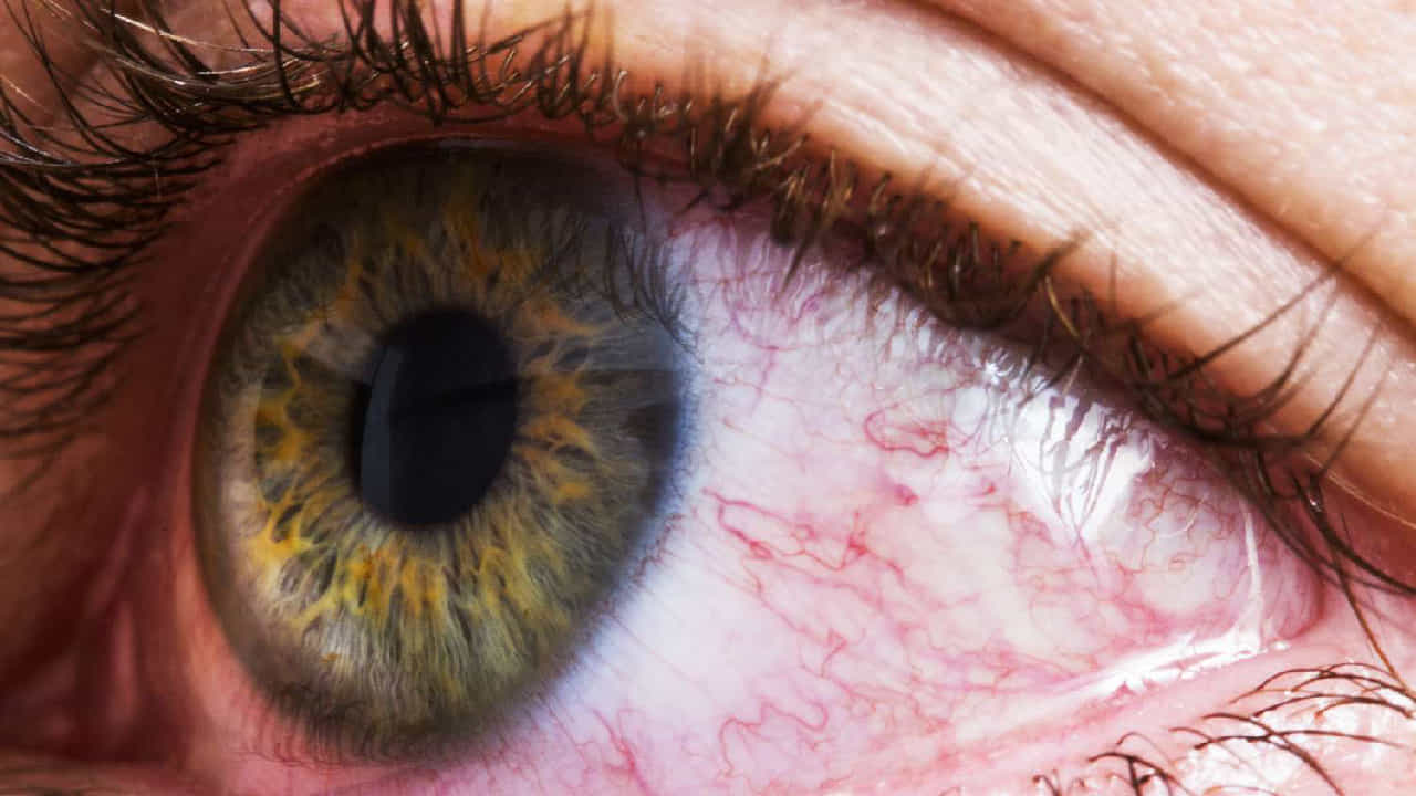 Hypertensive Retinopathy: ಅಧಿಕ ರಕ್ತದೊತ್ತಡವು ಕಣ್ಣುಗಳ ಮೇಲೆ ಪರಿಣಾಮ ಬೀರಬಹುದೇ? Hypertensive Retinopathy: ಅಧಿಕ ರಕ್ತದೊತ್ತಡವು ಕಣ್ಣುಗಳ ಮೇಲೆ ಪರಿಣಾಮ ಬೀರಬಹುದೇ?