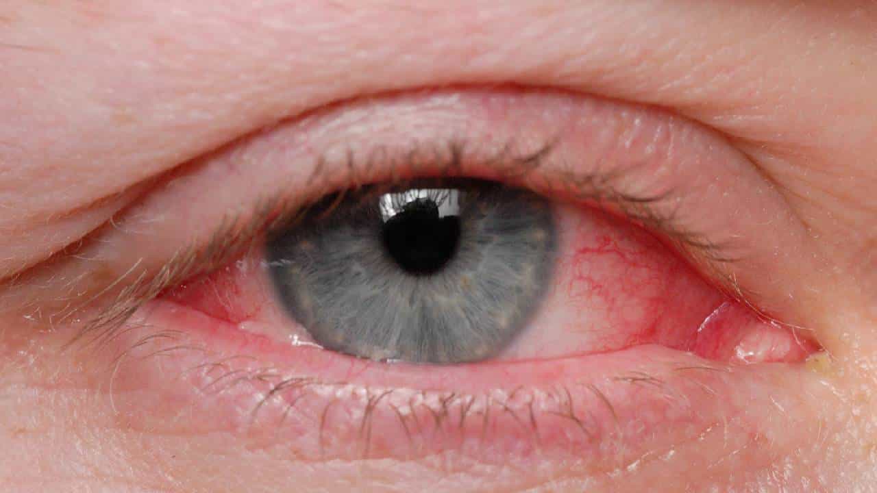 Conjunctivitis: ಬೆಂಗಳೂರಿನಲ್ಲಿ ಕಾಂಜಂಕ್ಟಿವಿಟಿಸ್ ಪ್ರಕರಣ ಹೆಚ್ಚಳ ; ಪೋಷಕರಲ್ಲಿ ಹೆಚ್ಚಿದ ಆತಂಕ Conjunctivitis: ಬೆಂಗಳೂರಿನಲ್ಲಿ ಕಾಂಜಂಕ್ಟಿವಿಟಿಸ್ ಪ್ರಕರಣ ಹೆಚ್ಚಳ ; ಪೋಷಕರಲ್ಲಿ ಹೆಚ್ಚಿದ ಆತಂಕ