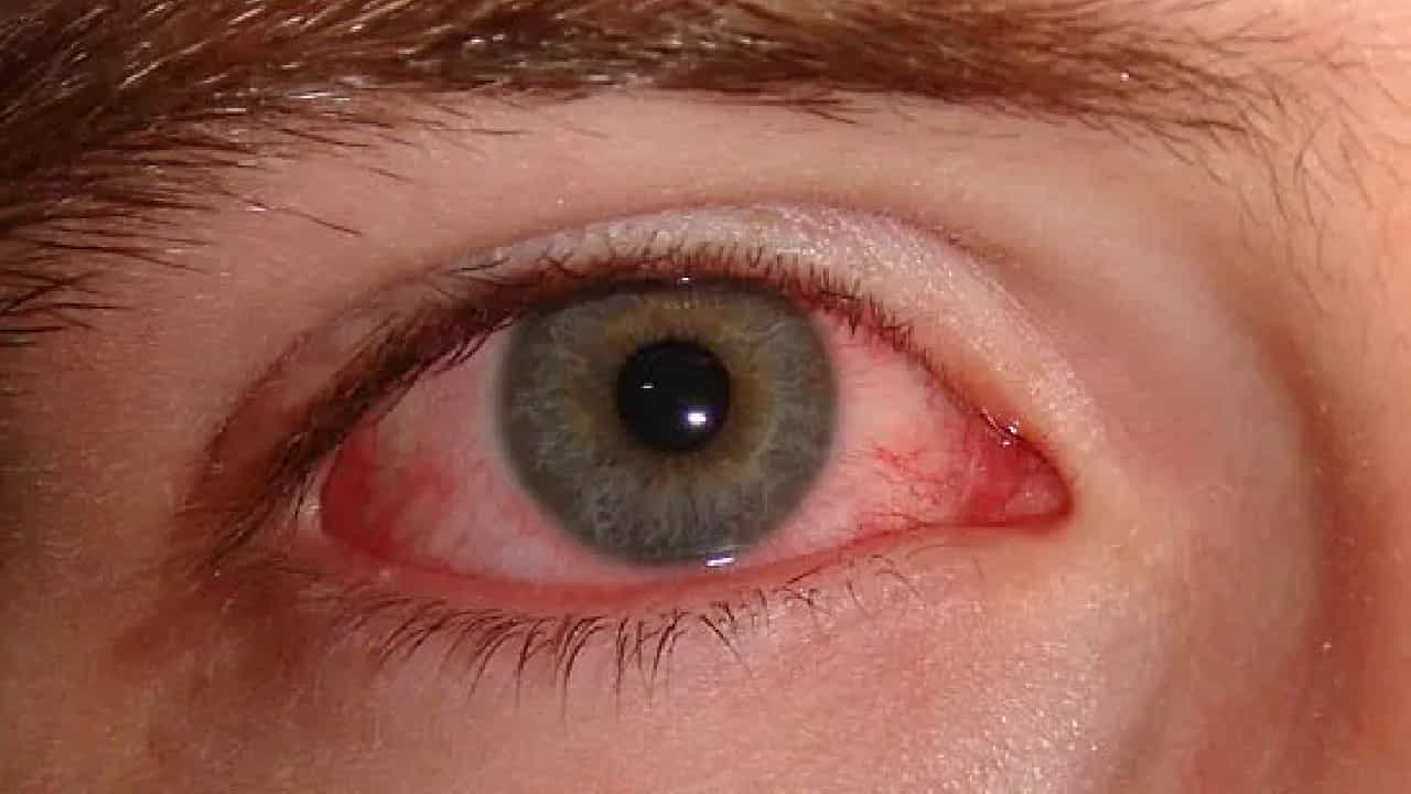 Conjunctivitis: ಮಳೆಗಾಲದಲ್ಲಿ ಕಂಡುಬರುವ ಕಾಂಜಂಕ್ಟಿವಿಟಿಸ್ ಸೋಂಕು ಎಂದರೇನು? ತಜ್ಞರು ನೀಡಿರುವ ಮಾಹಿತಿ ಇಲ್ಲಿದೆ Conjunctivitis: ಮಳೆಗಾಲದಲ್ಲಿ ಕಂಡುಬರುವ ಕಾಂಜಂಕ್ಟಿವಿಟಿಸ್ ಸೋಂಕು ಎಂದರೇನು? ತಜ್ಞರು ನೀಡಿರುವ ಮಾಹಿತಿ ಇಲ್ಲಿದೆ