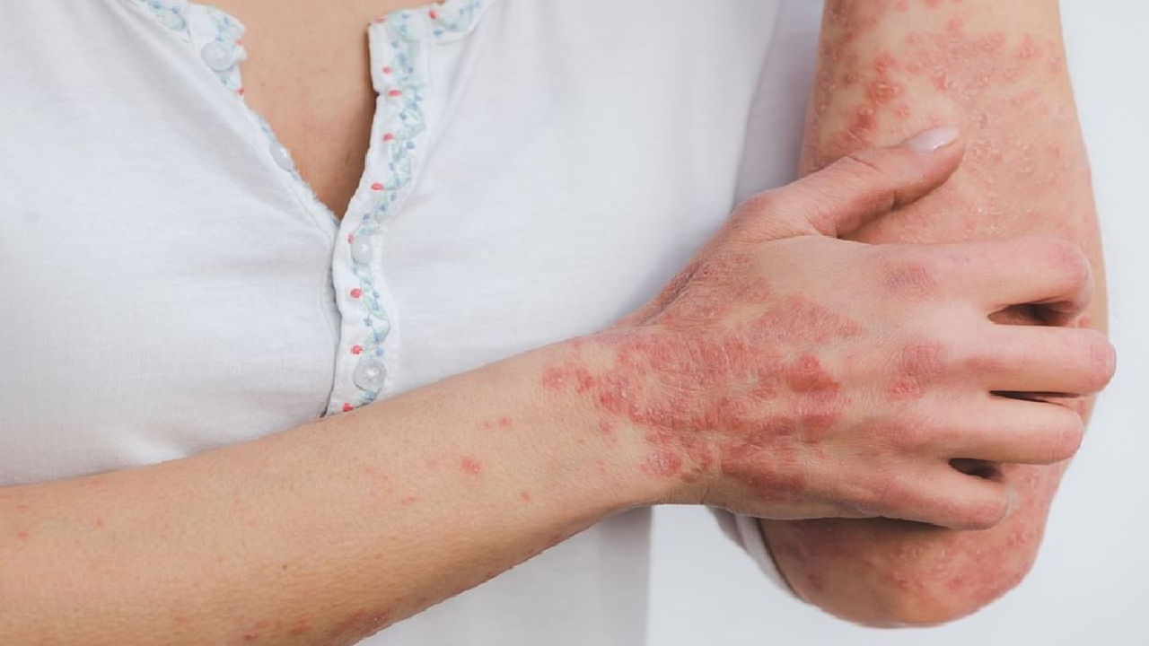 Skin Allergies: ಮಳೆಗಾಲದಲ್ಲಿ ಕಂಡುಬರುವ ಚರ್ಮದ ಅಲರ್ಜಿ ಸಮಸ್ಯೆಗೆ ತಜ್ಞರ ಸಲಹೆ