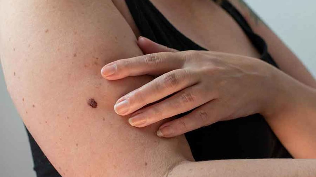 Skin cancer: ದೇಹದ ಮೇಲಿನ ಮಚ್ಚೆಯ ಆಕಾರವು ಬದಲಾಗುತ್ತಿದೆಯೇ? ಇದು ಚರ್ಮದ ಕ್ಯಾನ್ಸರ್​​ನ  ಅಪಾಯದ ಸೂಚಕವಾಗಿರಬಹುದು