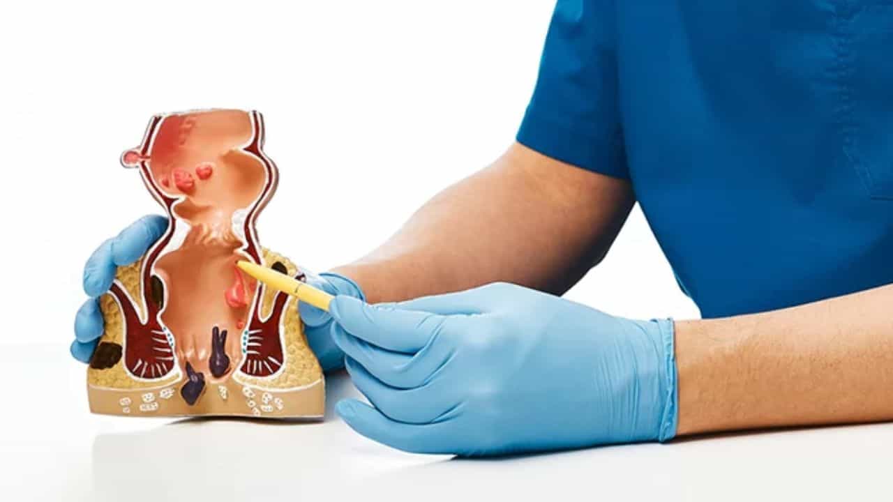 Pilonidal Sinus: ಪಿಲೋನಿಡಲ್ ಸೈನಸ್ ಕಾಯಿಲೆ ಎಂದರೇನು? ಅದರ ರೋಗಲಕ್ಷಣ, ಚಿಕಿತ್ಸಾ ವಿಧಾನ ಇಲ್ಲಿದೆ Pilonidal Sinus: ಪಿಲೋನಿಡಲ್ ಸೈನಸ್ ಕಾಯಿಲೆ ಎಂದರೇನು? ಅದರ ರೋಗಲಕ್ಷಣ, ಚಿಕಿತ್ಸಾ ವಿಧಾನ ಇಲ್ಲಿದೆ