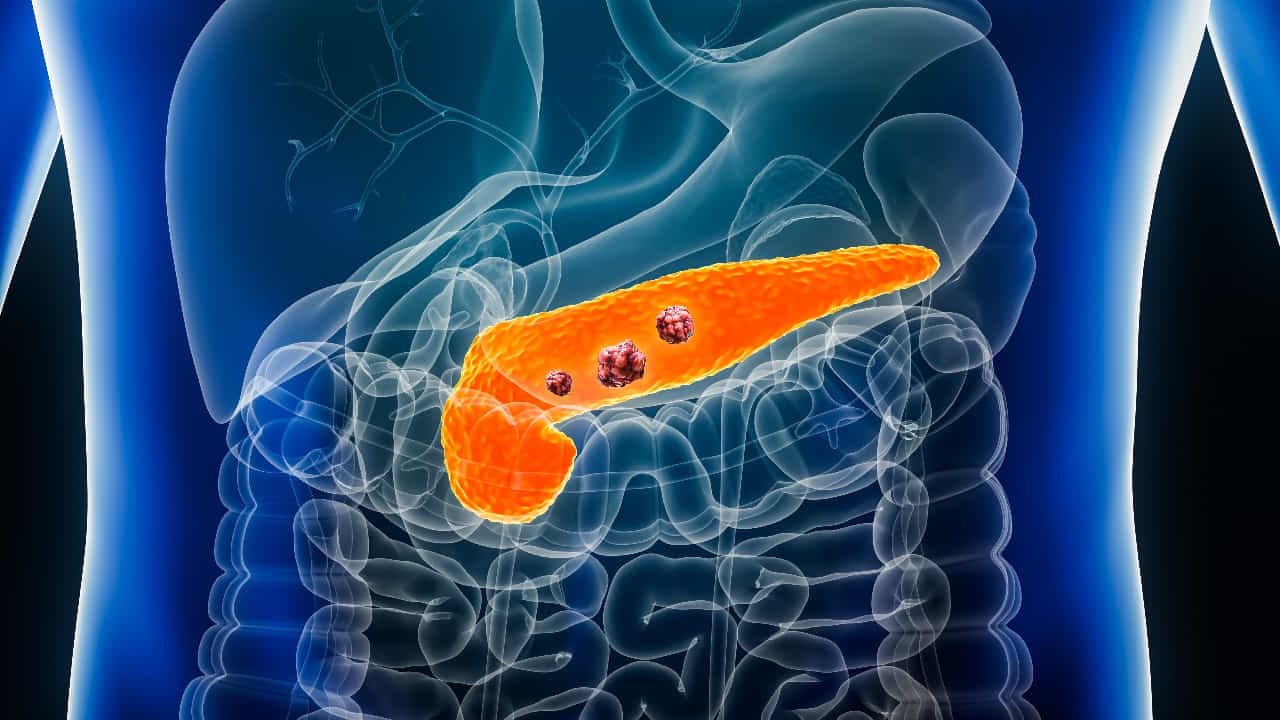 Pancreatic cancer: ಮೇದೋಜ್ಜೀರಕ ಗ್ರಂಥಿ ಕ್ಯಾನ್ಸರ್ನ ಆರಂಭಿಕ ಲಕ್ಷಣ ತಿಳಿದುಕೊಳ್ಳಿ Pancreatic cancer: ಮೇದೋಜ್ಜೀರಕ ಗ್ರಂಥಿ ಕ್ಯಾನ್ಸರ್ನ ಆರಂಭಿಕ ಲಕ್ಷಣ ತಿಳಿದುಕೊಳ್ಳಿ