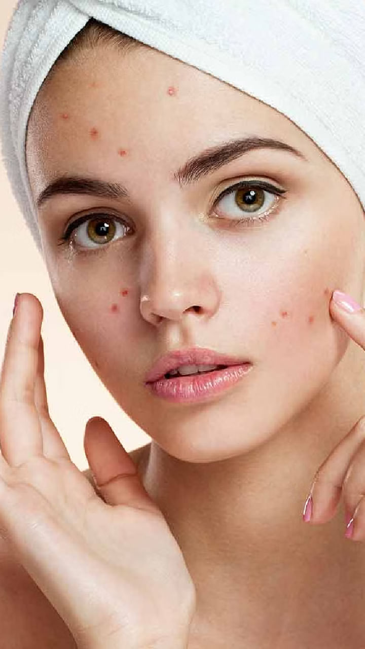 Pimples (6)