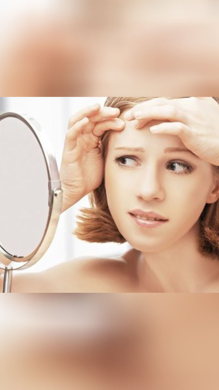 Forehead Acne (2)