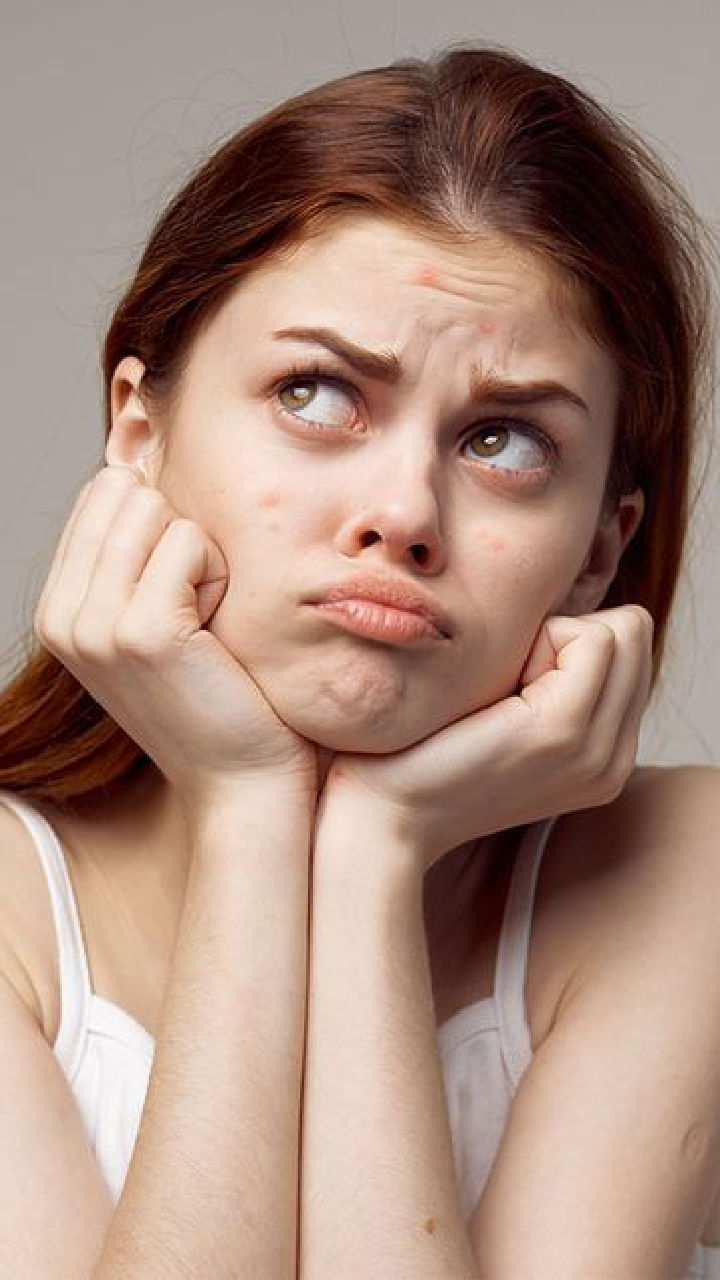 Forehead Acne