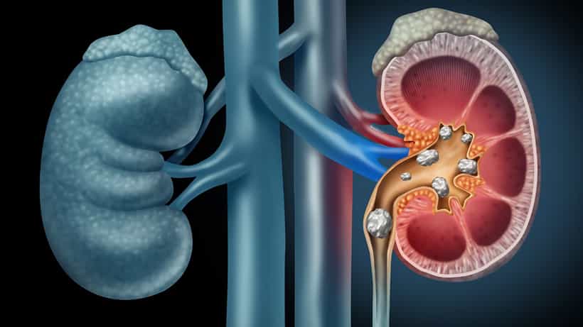 Kidney Stone Diet: ಕಿಡ್ನಿ ಸ್ಟೋನ್ ಸಮಸ್ಯೆಯಿಂದ ದೂರವಿರಲು ಈ ಪದಾರ್ಥಗಳನ್ನು ಮಿತವಾಗಿ ಸೇವಿಸಿ
