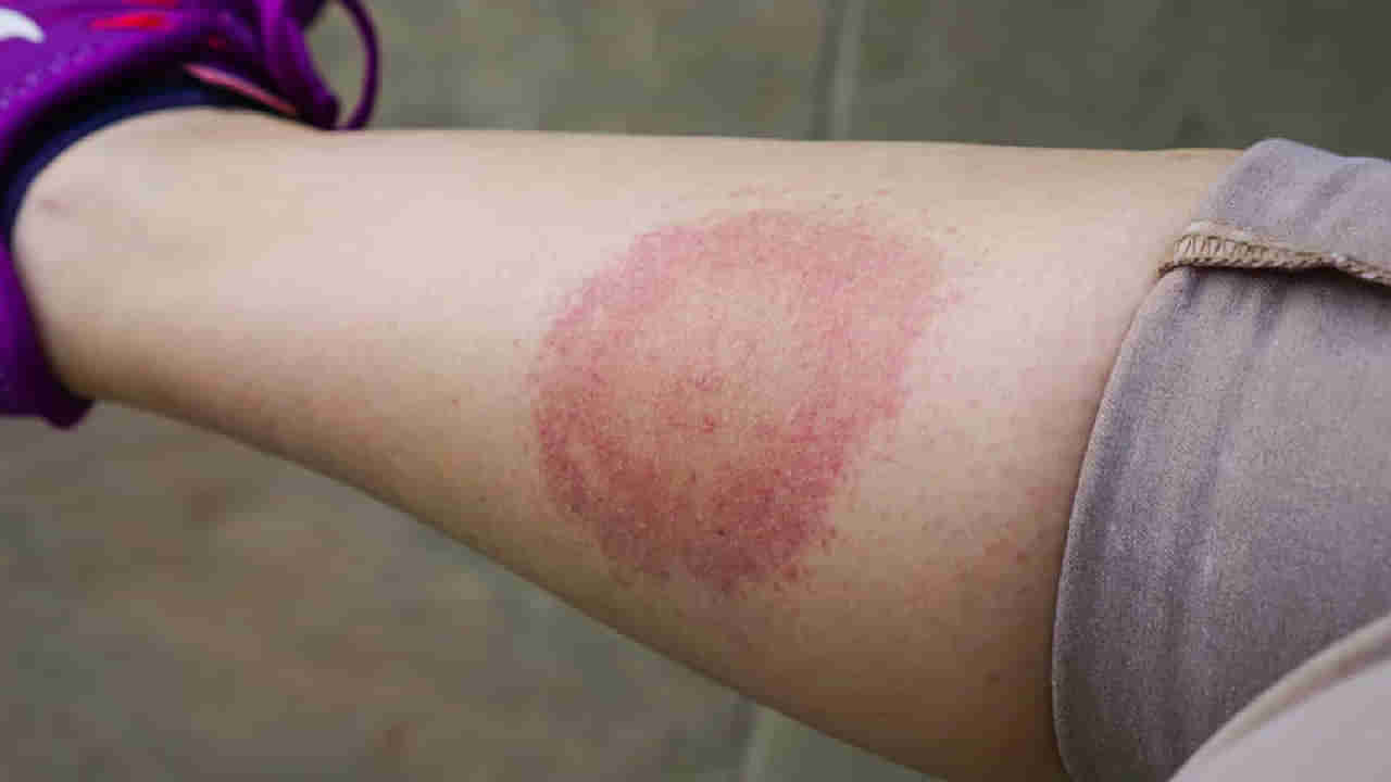 Lyme disease: ಲೈಮ್ ಡಿಸೀಸ್ ಎಂದರೇನು? ಈ ರೋಗದ ಬಗ್ಗೆ ಸೂಪರ್ ಮಾಡೆಲ್ ಬೆಲ್ಲಾ ಹ್ಯಾಡಿಡ್ ಅನುಭವ ಹೇಗಿತ್ತು? ಇಲ್ಲಿದೆ ತಜ್ಞರ ಸಲಹೆ