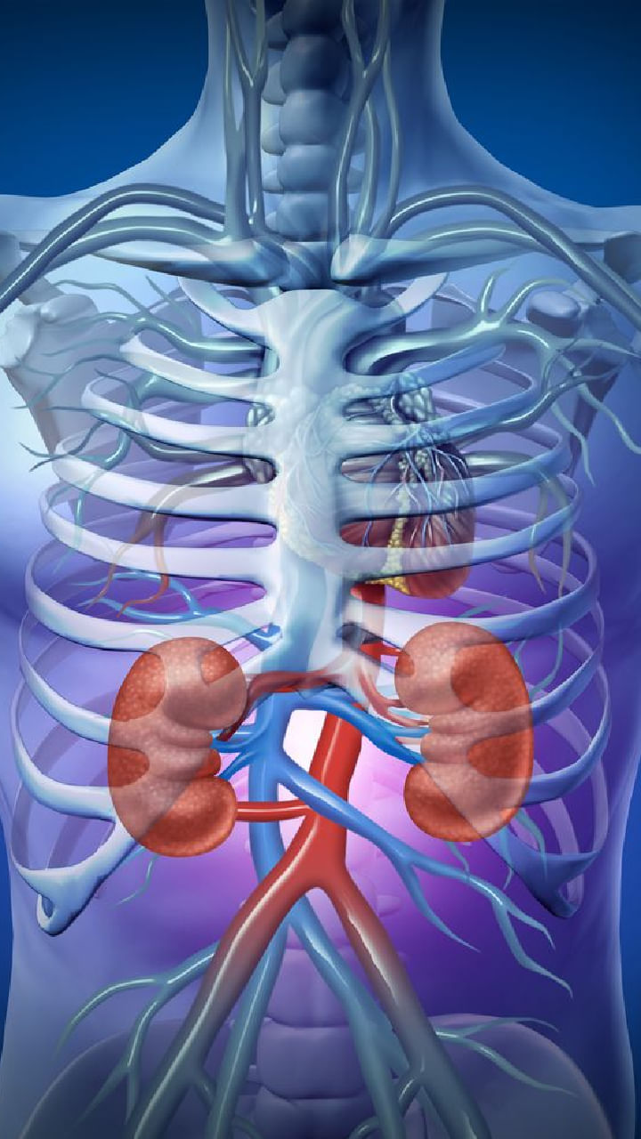 kidney stone (4)
