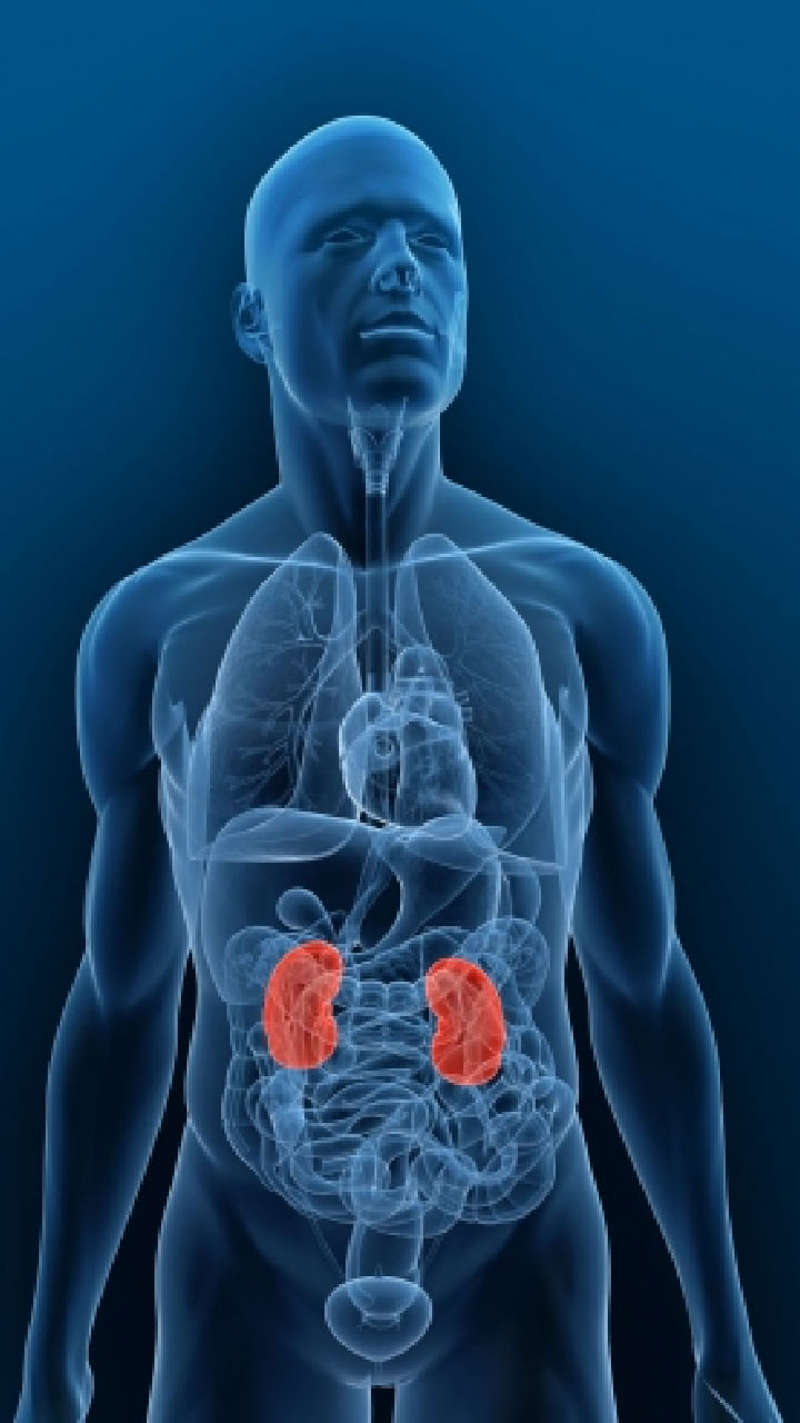 kidney stone (5)