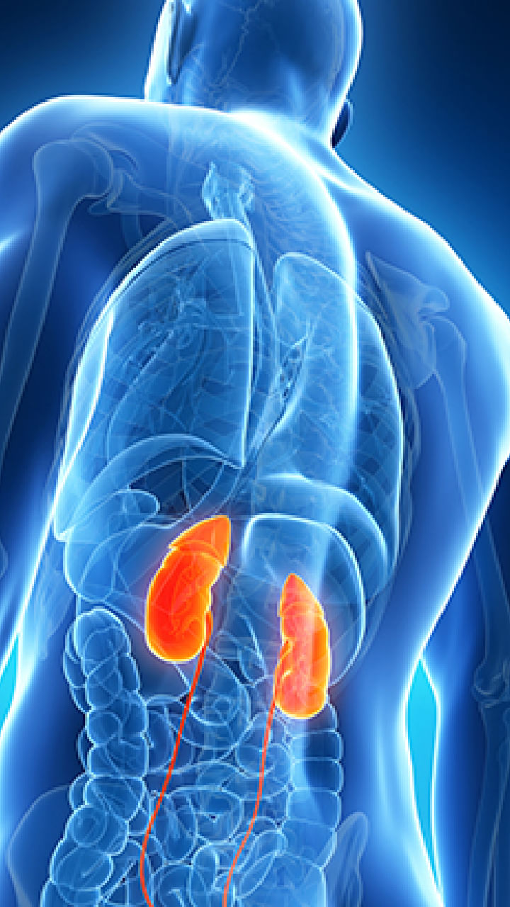 kidney stone (6)