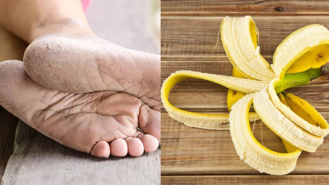 Banana Peel For Cracked Heels: ಒಡೆದ ಹಿಮ್ಮಡಿ ಸಮಸ್ಯೆಯಿಂದ ಮುಜುಗರಕ್ಕೆ ಒಳಗಾಗಿದ್ದೀರಾ? ಬಾಳೆಹಣ್ಣಿನ ಸಿಪ್ಪೆಯಲ್ಲಿದೆ ಸಮಸ್ಯೆಗೆ ಪರಿಹಾರ Banana Peel For Cracked Heels: ಒಡೆದ ಹಿಮ್ಮಡಿ ಸಮಸ್ಯೆಯಿಂದ ಮುಜುಗರಕ್ಕೆ ಒಳಗಾಗಿದ್ದೀರಾ? ಬಾಳೆಹಣ್ಣಿನ ಸಿಪ್ಪೆಯಲ್ಲಿದೆ ಸಮಸ್ಯೆಗೆ ಪರಿಹಾರ