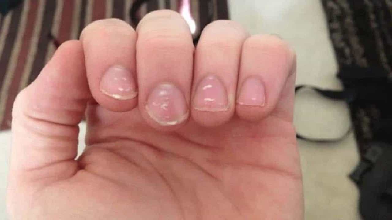 Nail Care: ಉಗುರಿನ ಮೇಲೆ ಬಿಳಿ ಚುಕ್ಕೆ ಉಂಟಾಗಲು ಕಾರಣವೇನು? Nail Care: ಉಗುರಿನ ಮೇಲೆ ಬಿಳಿ ಚುಕ್ಕೆ ಉಂಟಾಗಲು ಕಾರಣವೇನು?