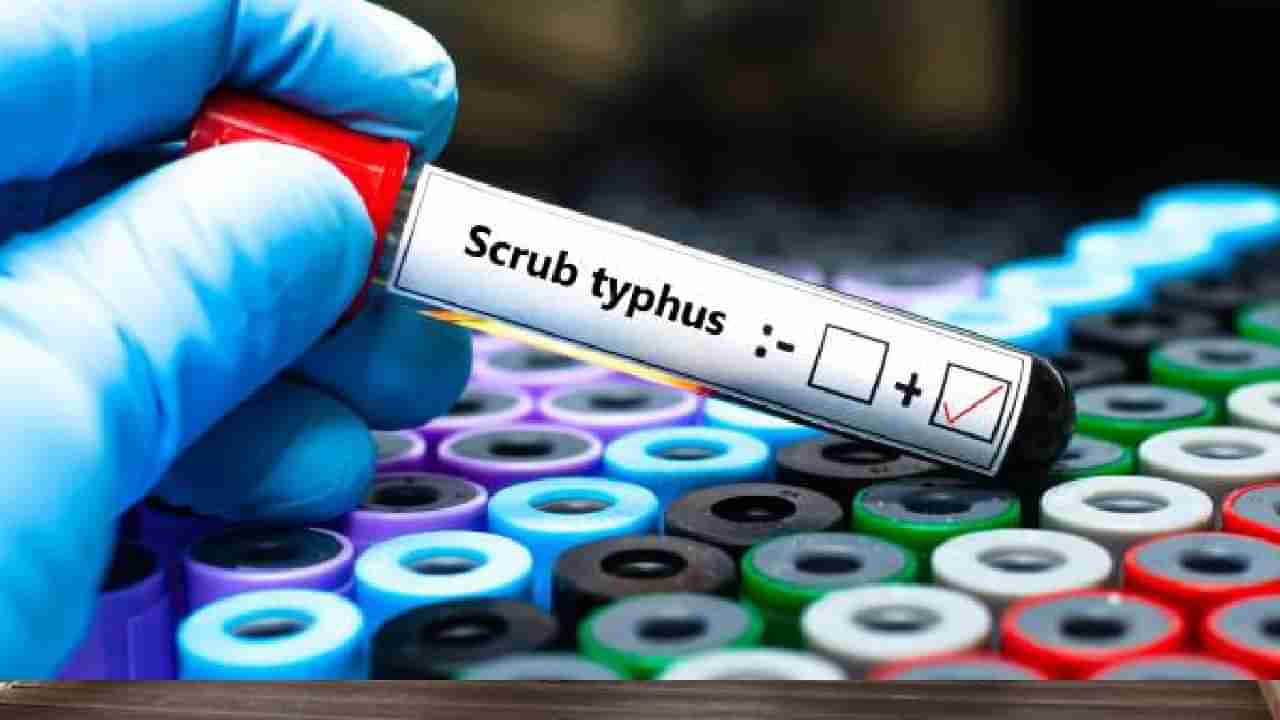 Scrub Typhus Infection: ಸ್ಕ್ರಬ್ ಟೈಫಸ್​ನಿಂದ ಭಾರತದಲ್ಲಿ 14 ಸಾವು; ಏನಿದು ಮಾರಕ ಸೋಂಕು?