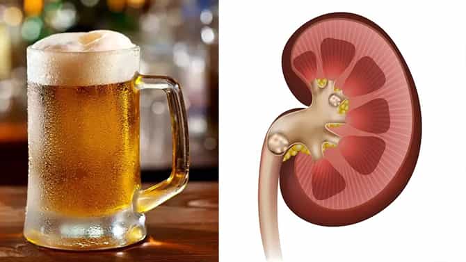 ಬಿಯರ್ ಕುಡಿಯುವುದರಿಂದ ಕಿಡ್ನಿ ಕಲ್ಲು ಸಮಸ್ಯೆಯಿಂದ ಮುಕ್ತಿ ಹೊಂದಬಹುದೇ?