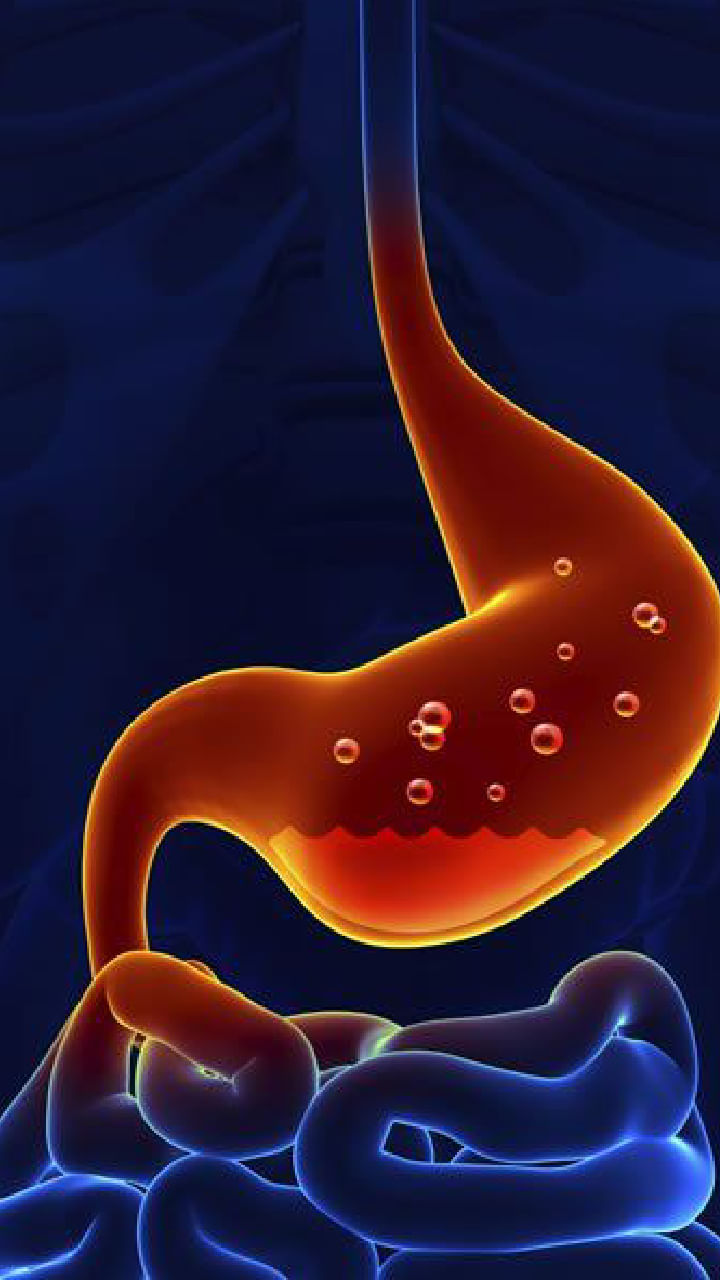 colorectal cancer (3)