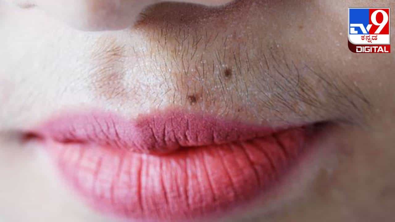 Upper Lips Hair Removal: ತುಟಿಯ ಮೇಲ್ಭಾಗದ ಅನಗತ್ಯ ಕೂದಲುಗಳನ್ನು ತೆಗೆದು ಹಾಕಲು ಸಿಂಪಲ್ ಮನೆಮದ್ದು ಇಲ್ಲಿದೆ Upper Lips Hair Removal: ತುಟಿಯ ಮೇಲ್ಭಾಗದ ಅನಗತ್ಯ ಕೂದಲುಗಳನ್ನು ತೆಗೆದು ಹಾಕಲು ಸಿಂಪಲ್ ಮನೆಮದ್ದು ಇಲ್ಲಿದೆ