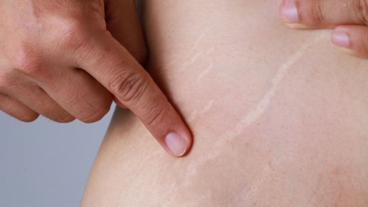 Stretch Marks Removal: ಸ್ಟ್ರೆಚ್ ಮಾರ್ಕ್ಸ್ ಸಮಸ್ಯೆಗೆ ಶಾಶ್ವತ ಪರಿಹಾರ ಈ 4 ಮನೆಮದ್ದು