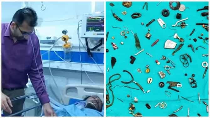 ವ್ಯಕ್ತಿಯ ಹೊಟ್ಟೆಯಲ್ಲಿತ್ತು ರಾಖಿ, ಇಯರ್​ಫೋನ್, ಕೀ ಸೇರಿ 100 ವಸ್ತುಗಳು