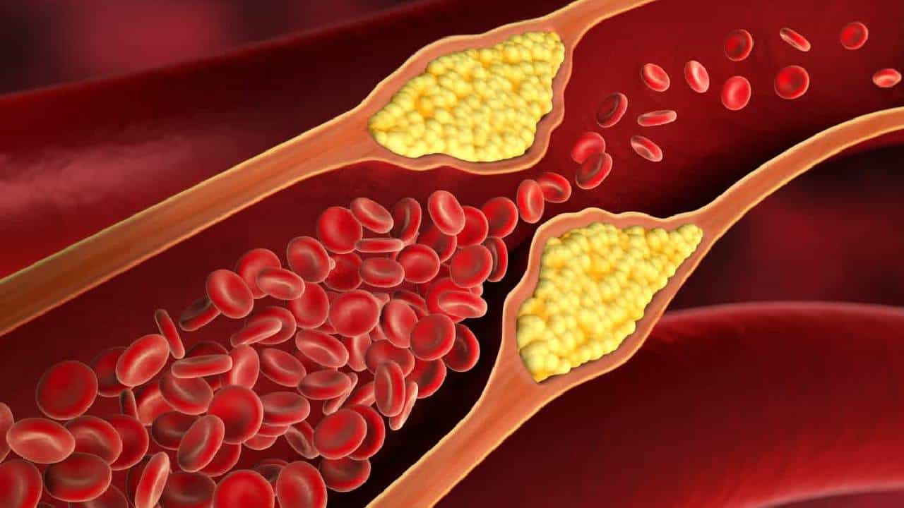 World Heart Day: ಅಧಿಕ ಕೊಲೆಸ್ಟ್ರಾಲ್ ಹೃದಯಾಘಾತ ಅಥವಾ ಹೃದಯ ಸ್ತಂಭನಕ್ಕೆ ನೇರ ಕಾರಣ; ಡಾ.ಮೀನಾಕ್ಷಿ ಮೋಹನ್ World Heart Day: ಅಧಿಕ ಕೊಲೆಸ್ಟ್ರಾಲ್ ಹೃದಯಾಘಾತ ಅಥವಾ ಹೃದಯ ಸ್ತಂಭನಕ್ಕೆ ನೇರ ಕಾರಣ; ಡಾ.ಮೀನಾಕ್ಷಿ ಮೋಹನ್