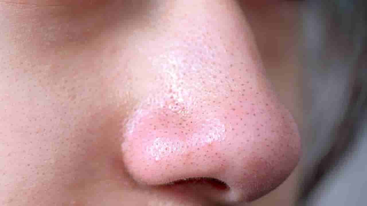 ಮುಖದಲ್ಲಿ ಬ್ಲಾಕ್ಹೆಡ್ಸ್ ಹೆಚ್ಚಾಗಲು ಕಾರಣವೇನು?; ಇದಕ್ಕೆ ಪರಿಹಾರವೇನು?