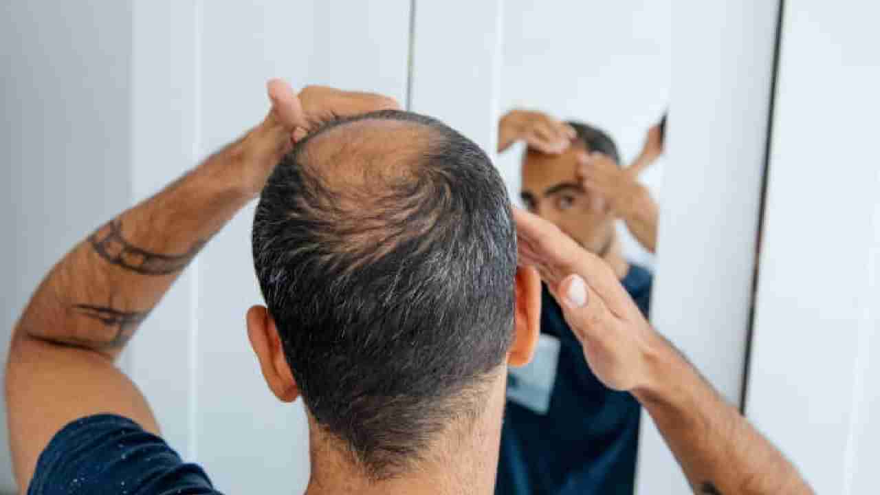 Hair Loss: ಕೂದಲು ಉದುರಲು ಕಾರಣವೇನು? ತಡೆಗಟ್ಟಲು ಏನು ಮಾಡಬೇಕು?