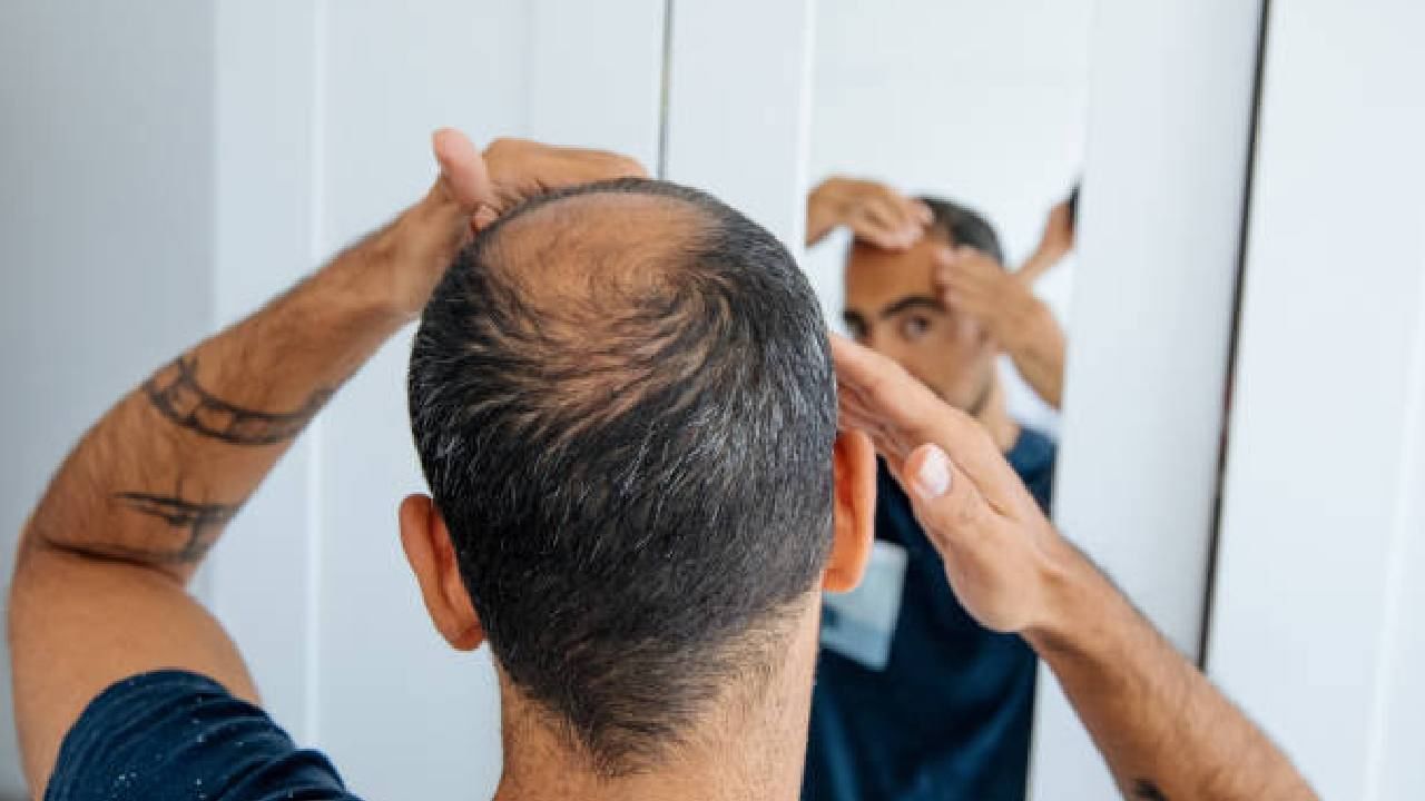 Hair Loss: ಕೂದಲು ಉದುರಲು ಕಾರಣವೇನು? ತಡೆಗಟ್ಟಲು ಏನು ಮಾಡಬೇಕು?