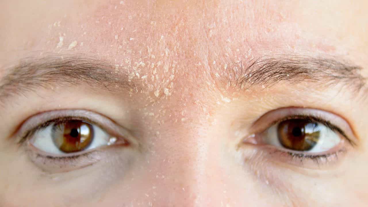 Foods For Dry Skin In Winter: ಚಳಿಗಾಲದಲ್ಲಿ ಕಾಡುವ ಶುಷ್ಕ ತ್ವಚೆಯ ಸಮಸ್ಯೆಯ ಮುಕ್ತಿಗೆ ಈ ಆಹಾರ ಸೇವಿಸಿ Foods For Dry Skin In Winter: ಚಳಿಗಾಲದಲ್ಲಿ ಕಾಡುವ ಶುಷ್ಕ ತ್ವಚೆಯ ಸಮಸ್ಯೆಯ ಮುಕ್ತಿಗೆ ಈ ಆಹಾರ ಸೇವಿಸಿ