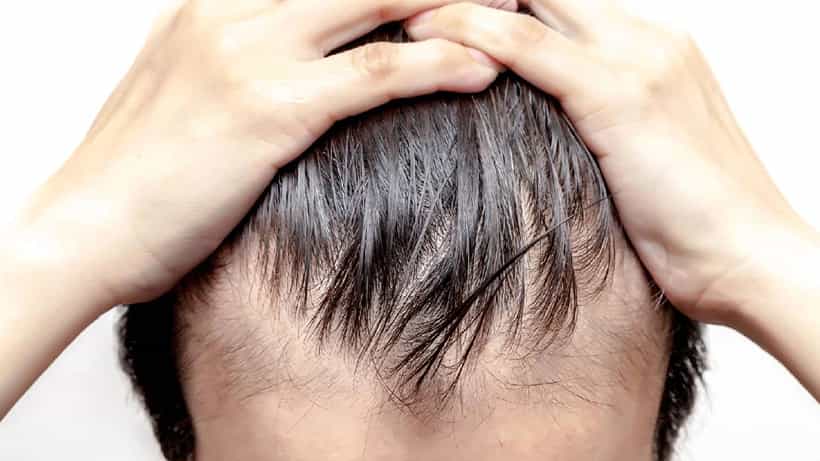 Male Baldness: ಪುರುಷರಲ್ಲಿ ಬೋಳು ತಲೆ ಸಮಸ್ಯೆಗೆ ಸಾಮಾನ್ಯ ಕಾರಣಗಳು