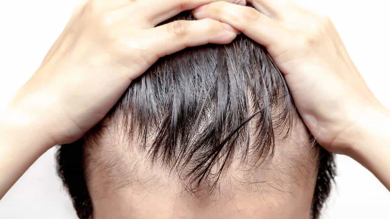 Male Baldness: ಪುರುಷರಲ್ಲಿ ಬೋಳು ತಲೆ ಸಮಸ್ಯೆಗೆ ಸಾಮಾನ್ಯ ಕಾರಣಗಳು Male Baldness: ಪುರುಷರಲ್ಲಿ ಬೋಳು ತಲೆ ಸಮಸ್ಯೆಗೆ ಸಾಮಾನ್ಯ ಕಾರಣಗಳು