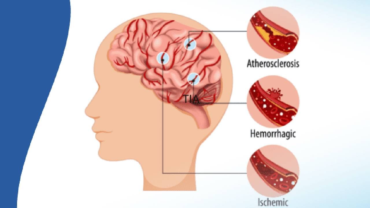 World Stroke Day: ಗರ್ಭನಿರೋಧಕ ಮಾತ್ರೆ ಮಹಿಳೆಯರಲ್ಲಿ ಪಾರ್ಶ್ವವಾಯು ಅಪಾಯವನ್ನು ಹೆಚ್ಚಿಸುತ್ತದೆ!