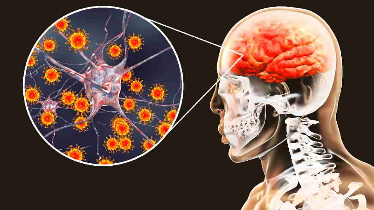 Brain Fever: ಮೆದುಳು ಜ್ವರ ಎಂದರೇನು? ಹೇಗೆ ಬರುತ್ತದೆ? ಲಕ್ಷಣ ಮತ್ತು ಚಿಕಿತ್ಸೆ ಏನು? ಸಂಪೂರ್ಣ ಮಾಹಿತಿ ಇಲ್ಲಿದೆ