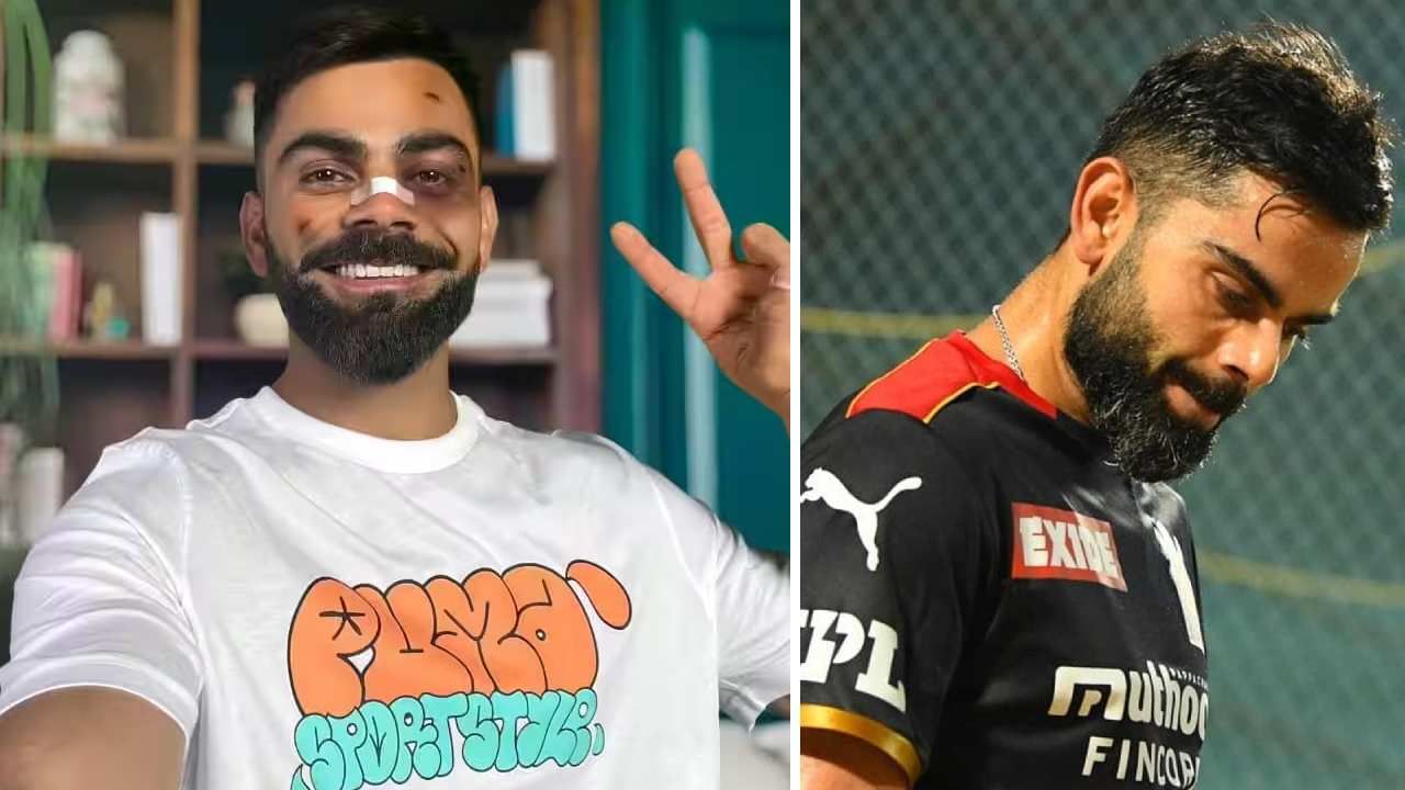 Virat Kohli: ವಿರಾಟ್ ಕೊಹ್ಲಿ ಹಣೆ-ಕೆನ್ನೆ ಮೇಲೆ ಗಾಯ, ಮೂಗಿನ ಮೇಲೆ ಬ್ಯಾಂಡೇಜ್: ವೈರಲ್ ಆಗ್ತಿದೆ ಫೋಟೋ