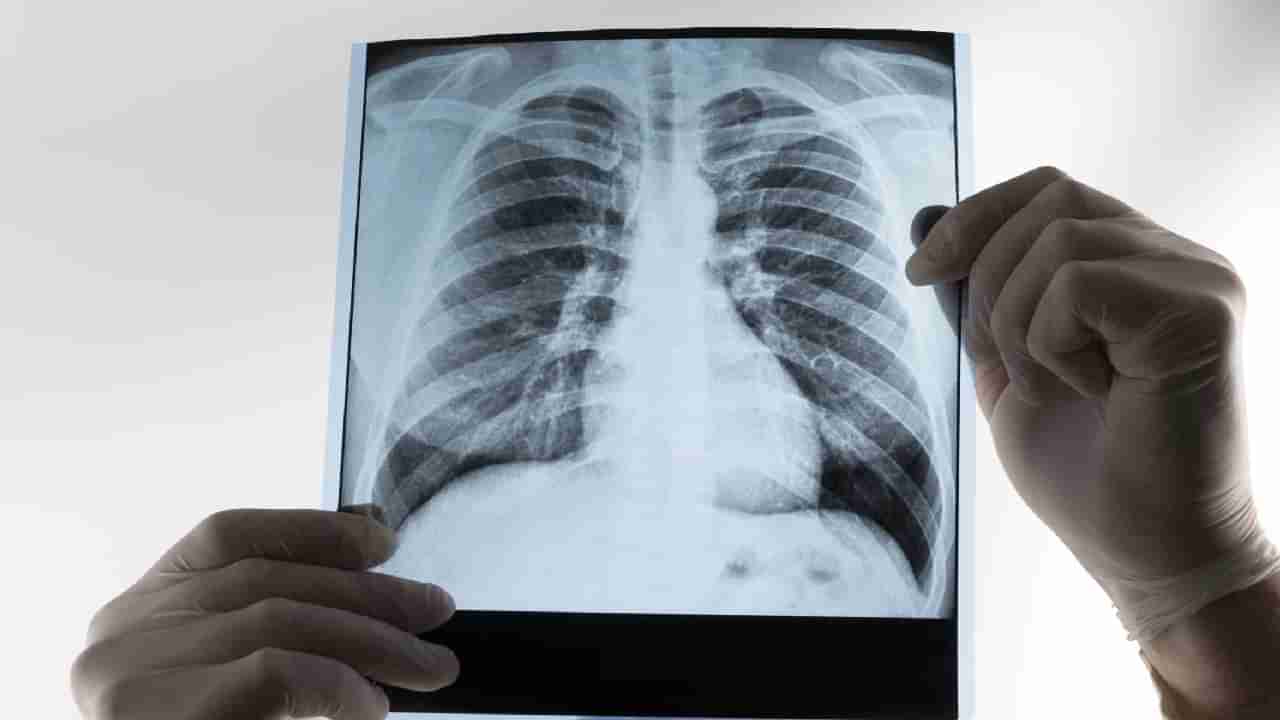 Popcorn Lungs: ಪಾಪ್‌ಕಾರ್ನ್ ಶ್ವಾಸಕೋಶ  ಎಂದರೇನು? ಅದರ ಲಕ್ಷಣ,ಕಾರಣ ಮತ್ತು ಚಿಕಿತ್ಸೆಯ ಬಗ್ಗೆ  ತಿಳಿಯಿರಿ