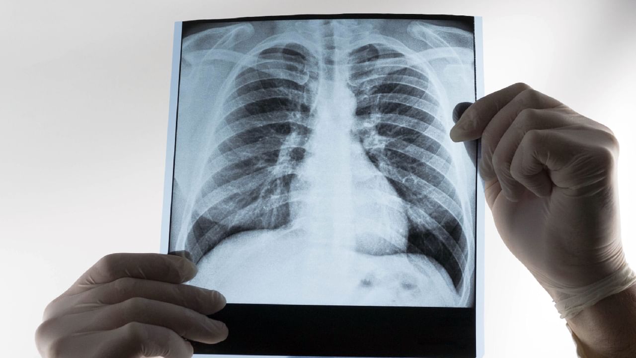 Popcorn Lungs: ಪಾಪ್ಕಾರ್ನ್ ಶ್ವಾಸಕೋಶ ಎಂದರೇನು? ಅದರ ಲಕ್ಷಣ,ಕಾರಣ ಮತ್ತು ಚಿಕಿತ್ಸೆಯ ಬಗ್ಗೆ ತಿಳಿಯಿರಿ