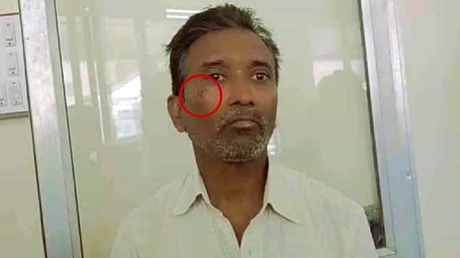 ಆ ಪುರುಷ ಪ್ರಯಾಣಿಕ ಕಂಡಕ್ಟರ್ ಕೆನ್ನೆ ಕಚ್ಚಿಬಿಟ್ಟ, ಯಾಕೆ ಗೊತ್ತಾ!?